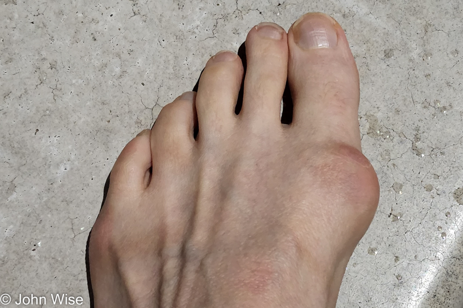 Caroline Wise's foot has a bunion