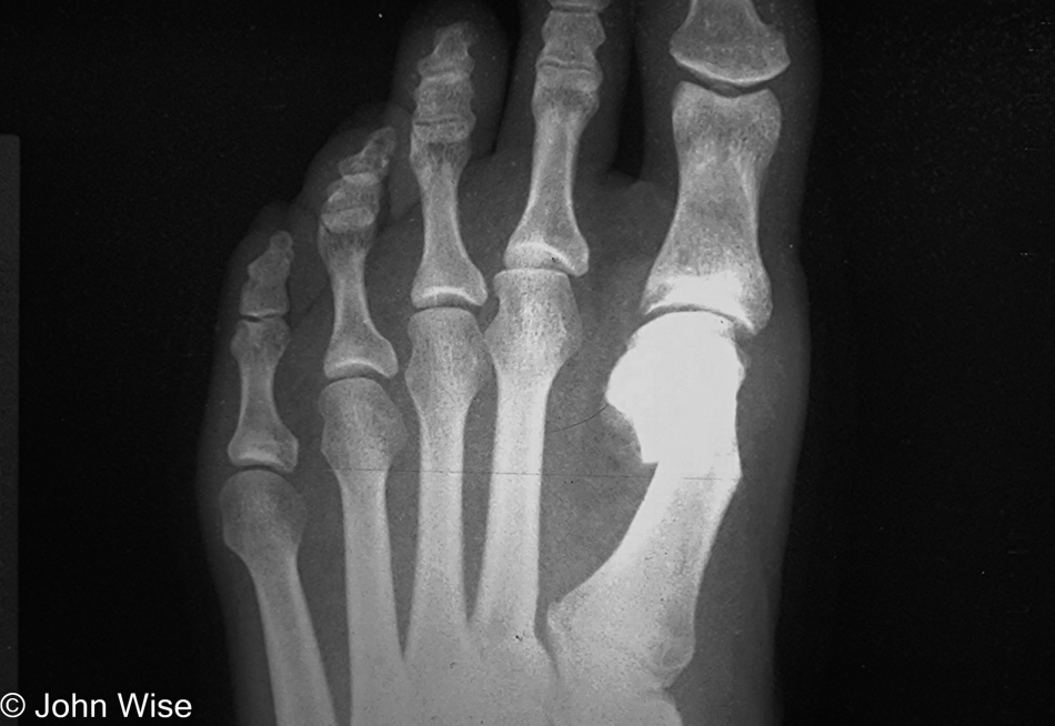 X-ray of Caroline Wise's missing bunion in Phoenix, Arizona